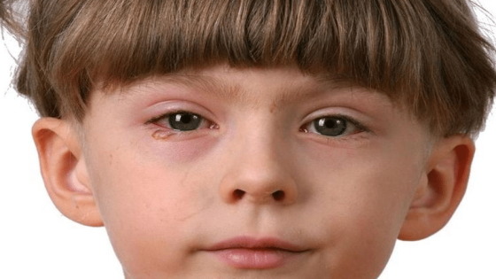 حساسية العيون للاطفال