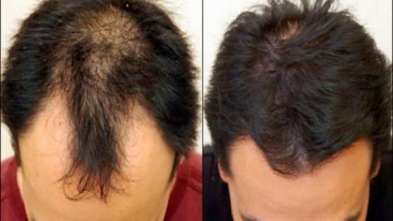 افضل 17 علاج لتساقط الشعر عند الرجال